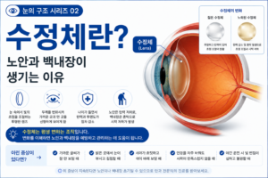 수정체 썸네일